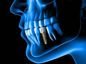 An x-ray film of teeth